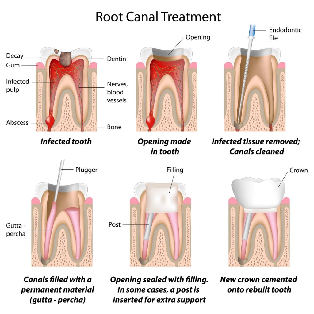 Comprehensive Guide to Root Canal Treatment and Procedures at V Dental, Gajuwaka The Root Canal Procedure at V Dental Gajuwaka