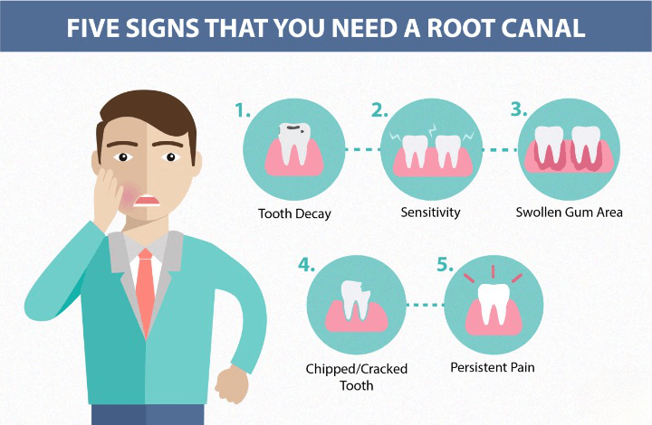 Comprehensive Guide to Root Canal Treatment and Procedures at V Dental, Gajuwaka to Root Canal Treatment and Procedures