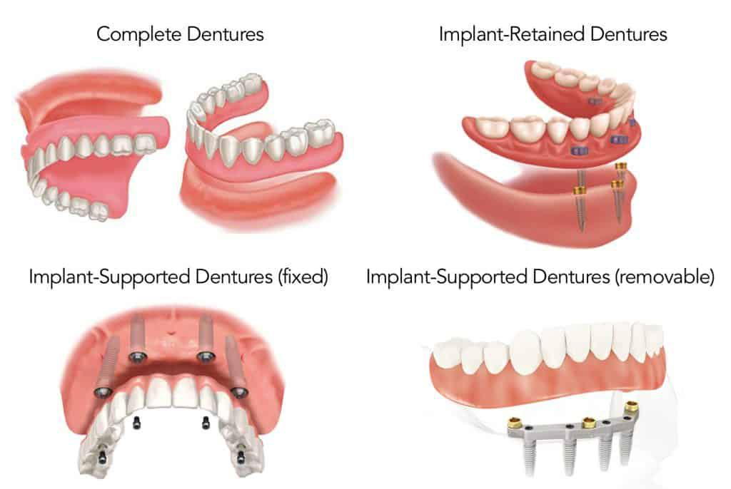 DENTURES type of dentures