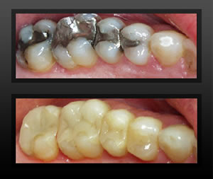 DENTAL FILLING TOOTH COLORED FILLING 2