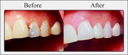 DENTAL FILLING TOOTH COLORED FILLING 4