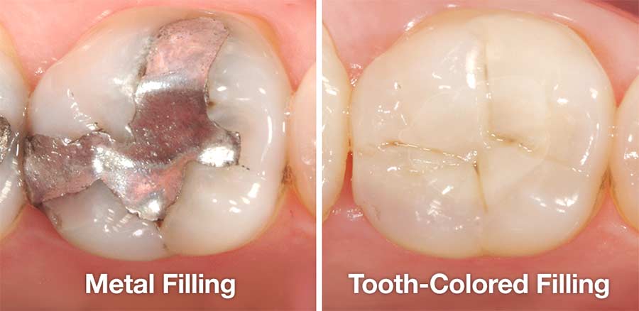 DENTAL FILLING TOOTH COLORED FILLING V Dental Gajuwaka