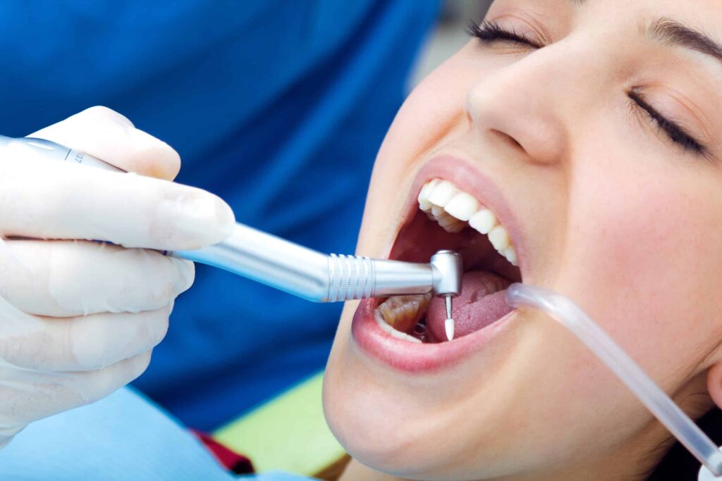 DENTAL FILLING TOOTH COLORED FILLINg 5
