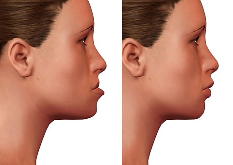 Orthognathic surgery 1