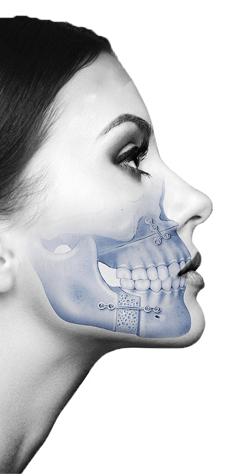 Orthognathic surgery 2