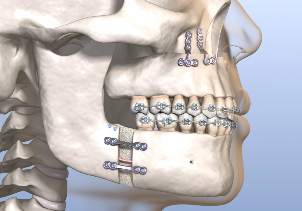 Orthognathic surgery 4