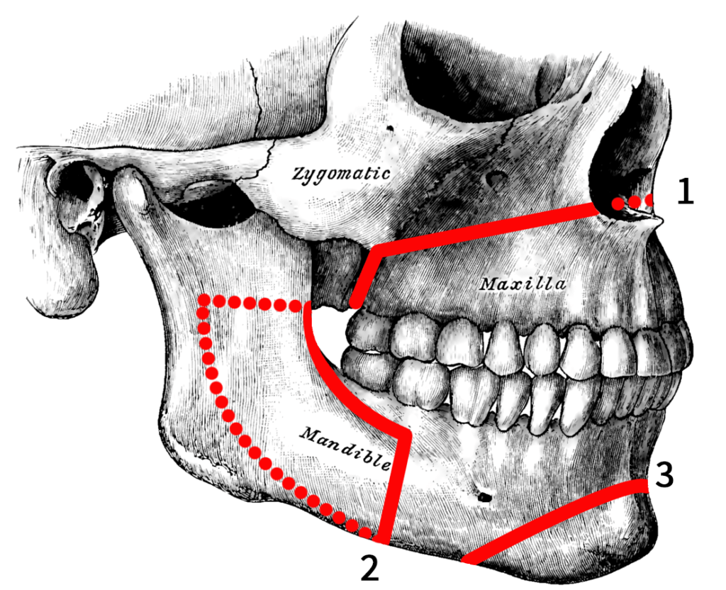Orthognatic surgery v dental gajuwaka