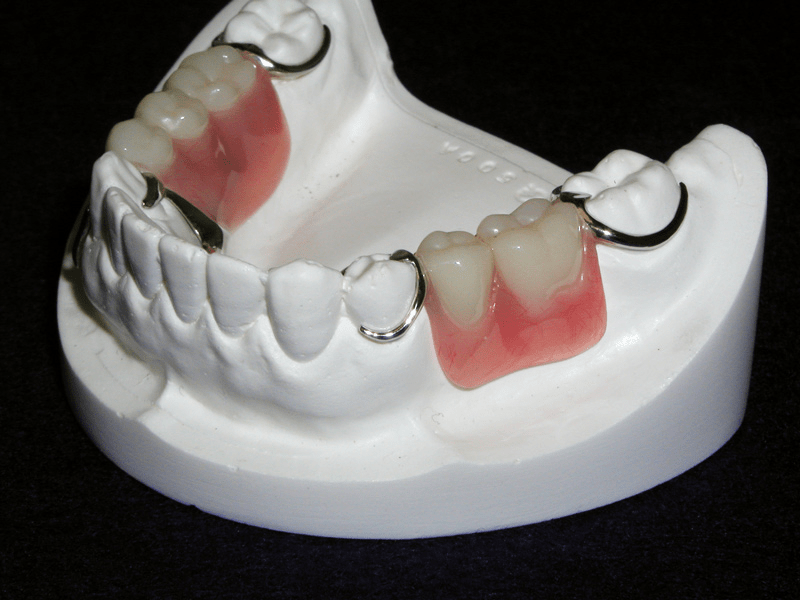 Removable Partial Dentures 1