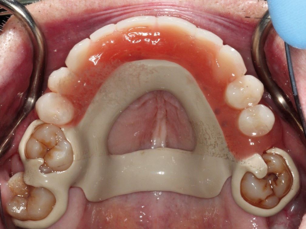 Removable Partial Dentures 3
