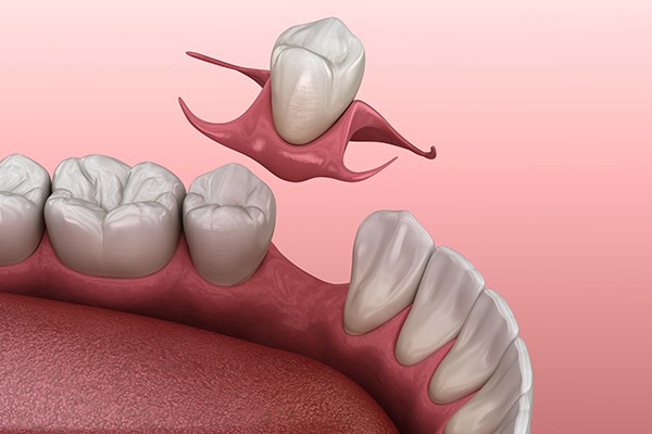 Removable Partial Dentures 4