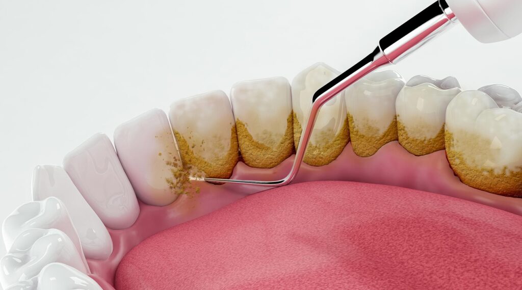 SCALING AND POLISHING 5