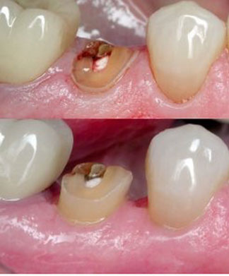 crownlength at v dental gajuwaka 1