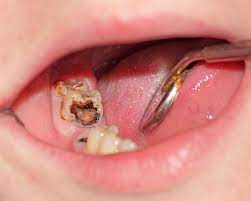 crownlength at v dental gajuwaka 2
