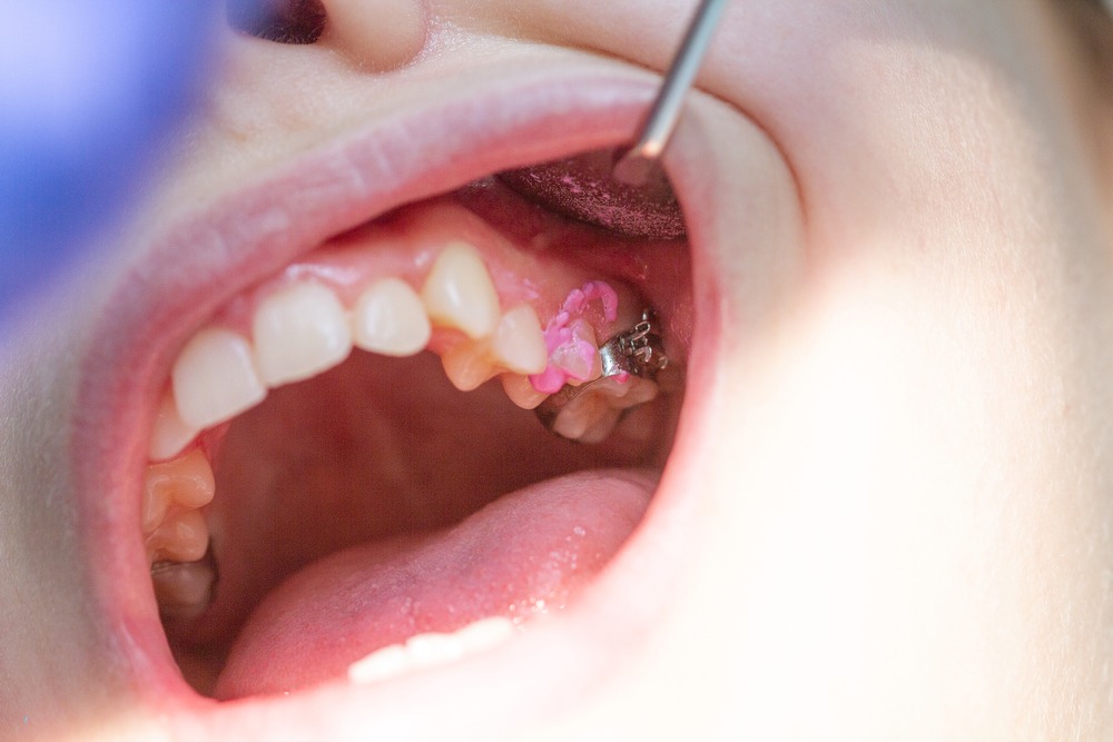 crownlength at v dental gajuwaka 3