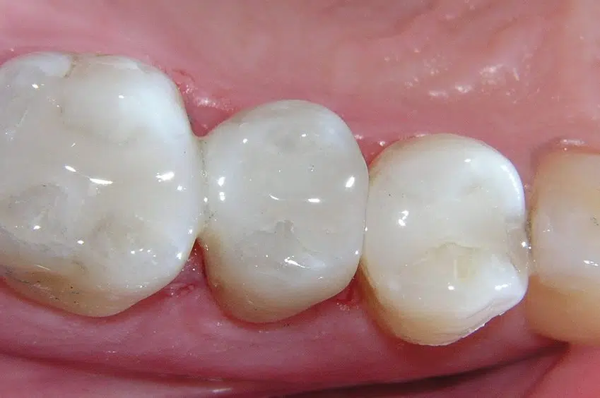tooth colored filling v dental gajuwaka