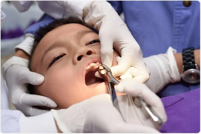 DENTAL EXTRACTION 1