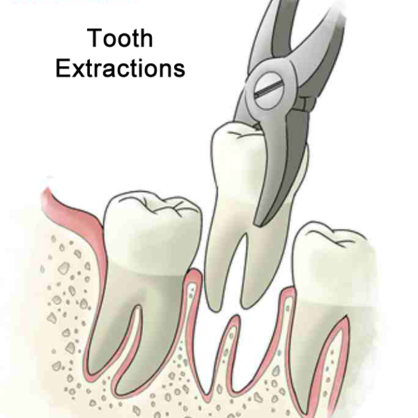 DENTAL EXTRACTION 2