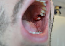DENTAL EXTRACTION 3