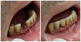 DENTAL EXTRACTION 4