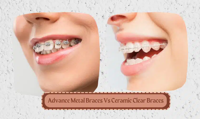 Metal ceramic braces 1