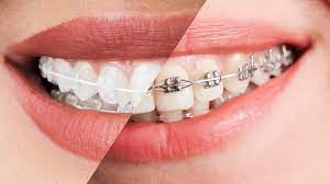 Metal ceramic braces 2