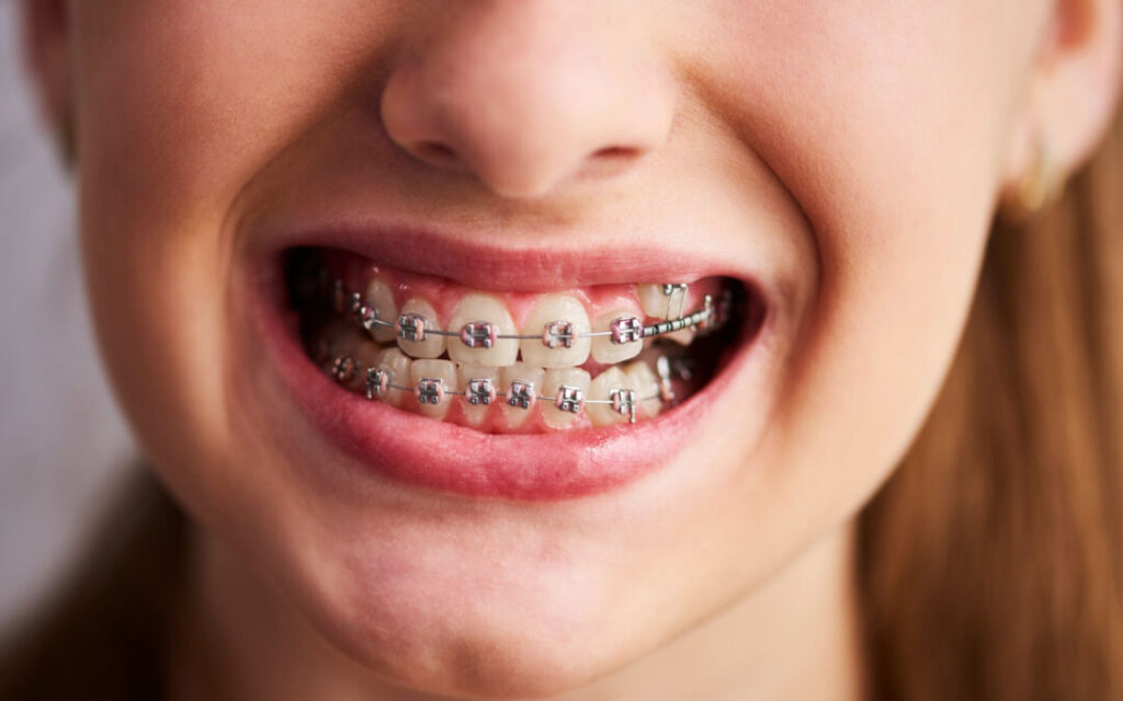 Metal ceramic braces 4