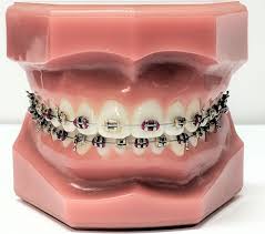 Metal ceramic braces 5