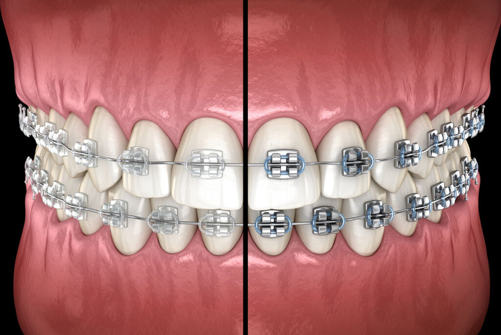 Metalceramicbraces v dental gajuwaka