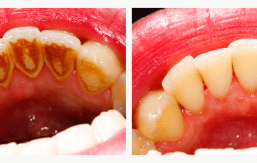 dental scaling and polishing 1
