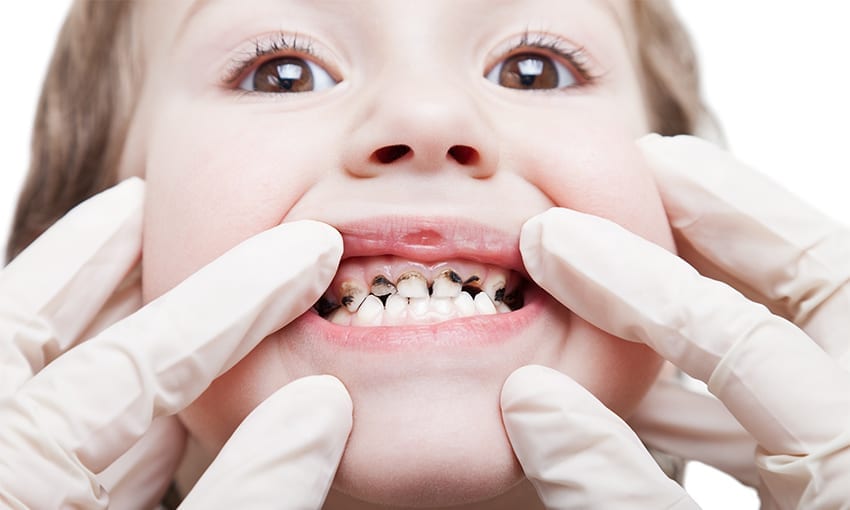 DENTAL CARIES IN CHILDREN DENTAL CARIES IN CHILDREN at V Dental