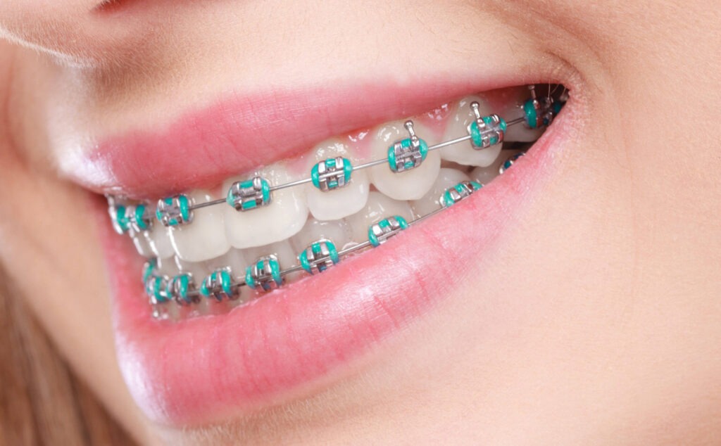 Benfits of Braces for Teeth Alignment @ V Dental Gajuwaka Braces at V Dental Gajuwaka