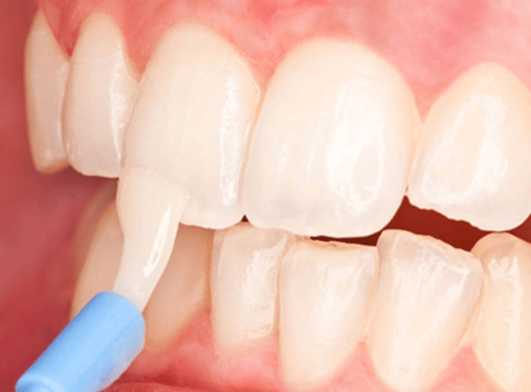 Fluoride Treatment: Benefits and Safety | V Dental Gajuwaka
