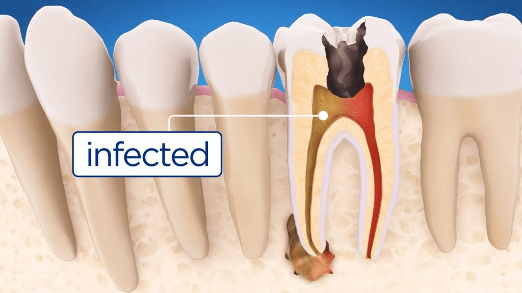 a diagram of teeth with decay