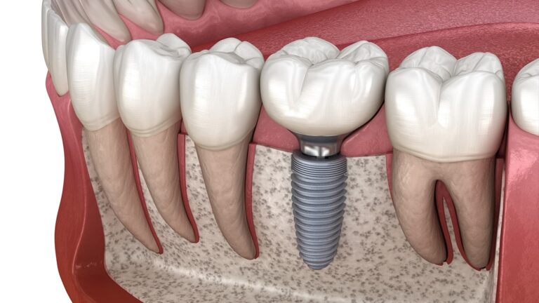 Dental Implants Aftercare: The Do’s and Don’ts for Long-Term Success | V Dental Hospitals, Gajuwaka