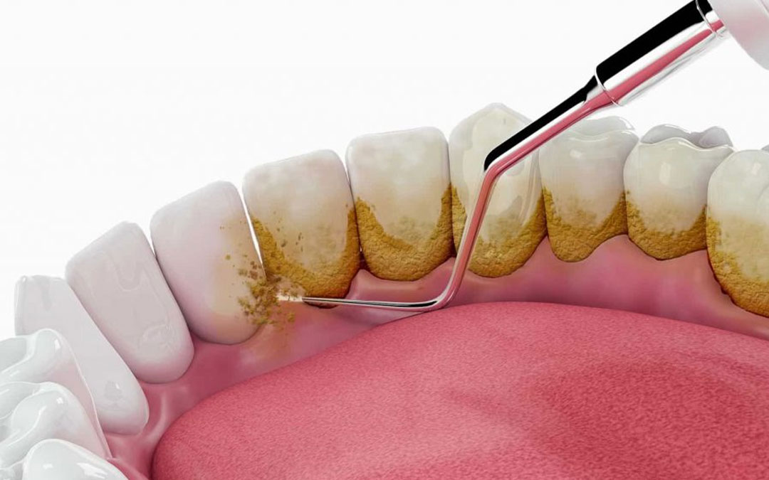 Does Regular Scaling or cleaning of Teeth damage the Tooth Enamel vdental gajuwaka