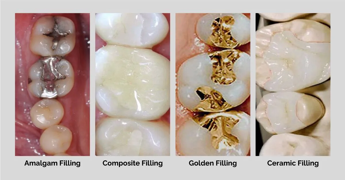 dantkriti tooth fillings v dental gajuwaka
