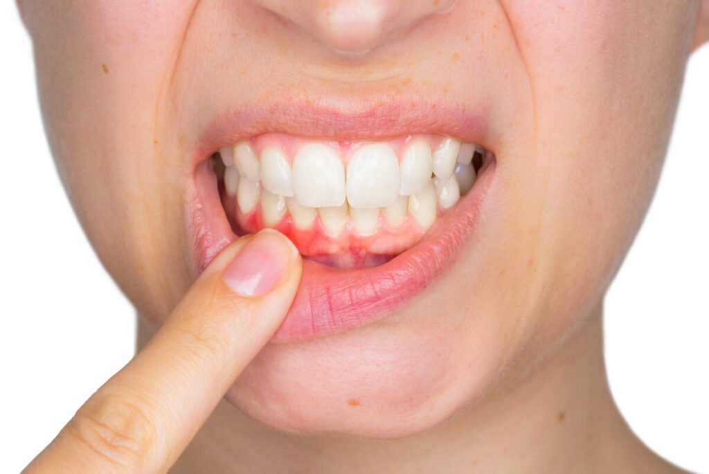 Healing Teeth Gums at v dental gajuwaka