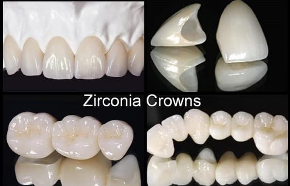 Zirconia dental crown v denta gajuwaka